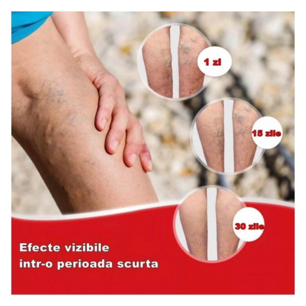 Set 24 Plasturi pentru Varice, Reduc Disconfortul si Oboseala Picioarelor - PromotiiZilnice